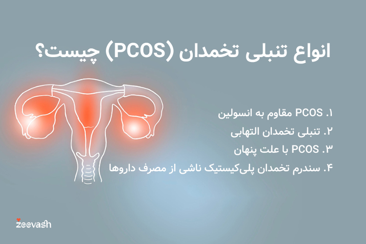 انواع تنبلی تخمدان شامل تنبلی تخمدان التهابی، مقاوم به انسولین، ناشی از مصرف داروها یا با علت پنهان است.